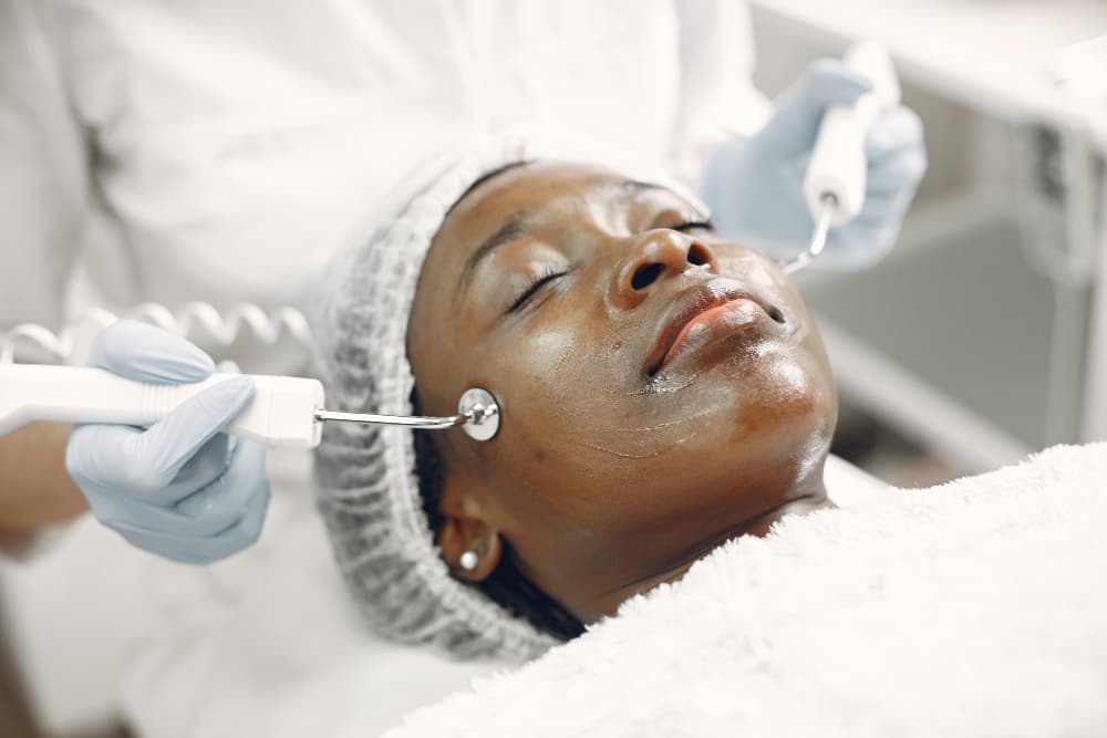 Résultat de microneedling sur le visage